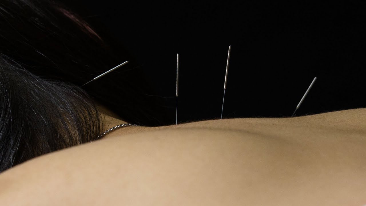 How does Acupuncture work? Alberta College of Acupuncture & Traditional Chinese Medicine, Calgary