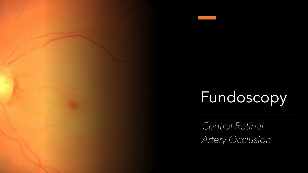 Central Retinal Artery Occlusion (CRAO): Fundoscopy