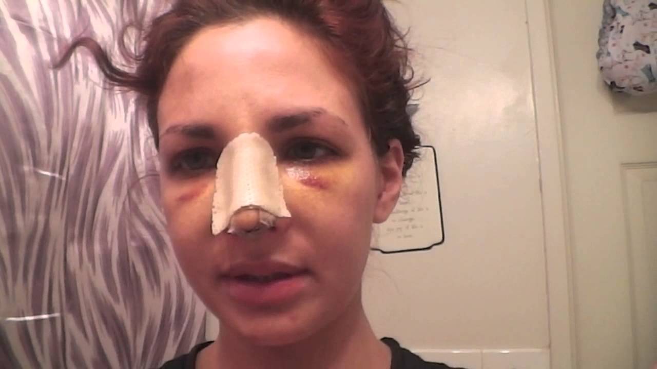 Rhinoplasty Diary: Day 5 After Surgery with Dr. Robert Guida
