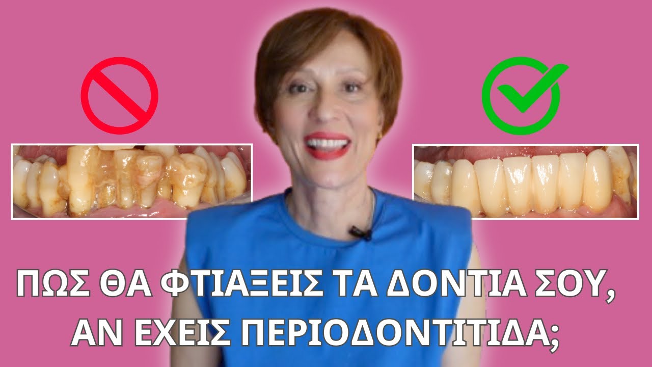 ΠΡΟΣΘΕΤΙΚΗ  δοντιών, για ασθενείς με  ΠΕΡΙΟΔΟΝΤΙΤΙΔΑ