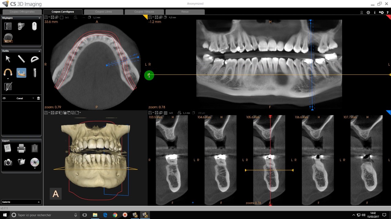CS 3D Imaging - Déplacement dans les différentes coupes