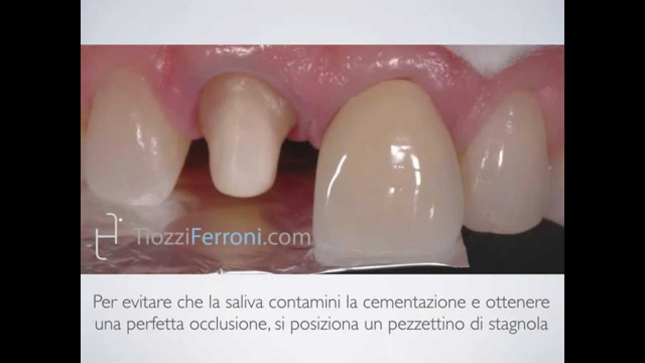 Ecco perchè cementare una corona non è attaccare un dente