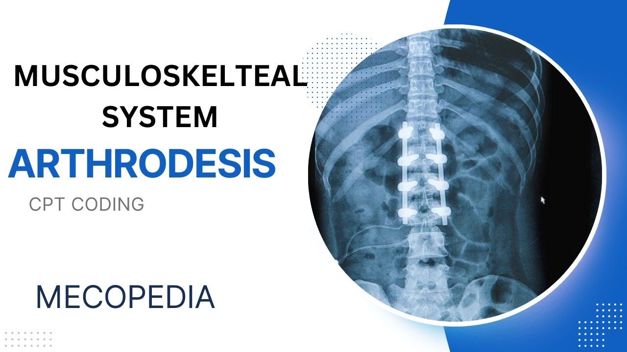 Arthrodesis CPT coding I Musculoskeletal System CPT Malayalam Explanation I CPT Malayalam I