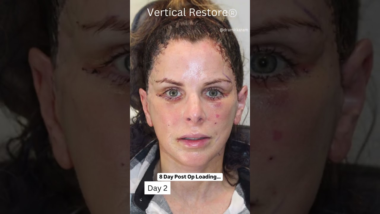 8-DAY Vertical Restore Facelift Healing & Recovery Progression!