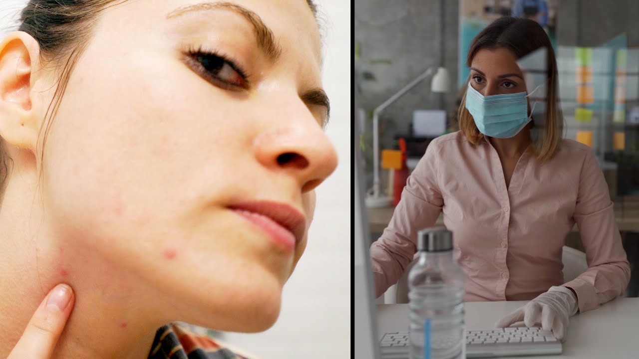 How to Prevent Acne Caused by Wearing Face Masks