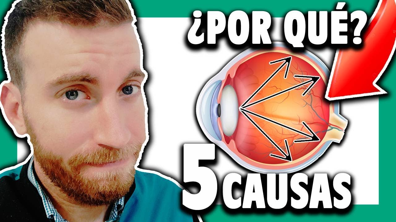 🟢 ¿Qué es el GLAUCOMA y por qué se produce? #1