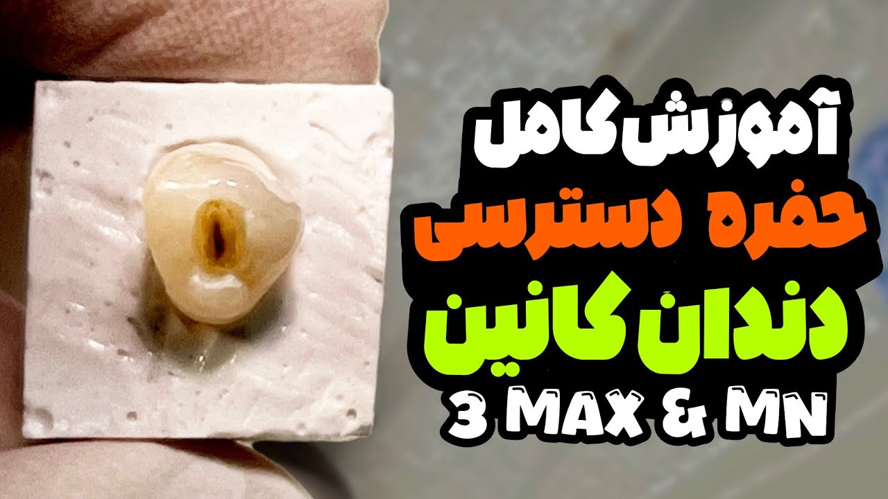 access cavity of upper & lower canine 3 step by step/ تهیه حفره دسترسی دندان کانین بالا و پایین
