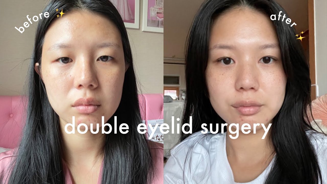 i got double eyelid surgery