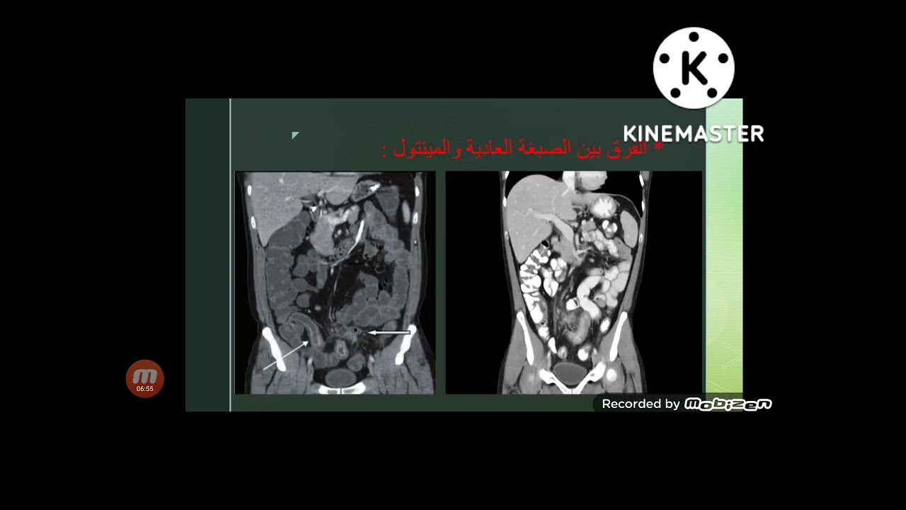 CT ENTEROGRAPHY كيفية عمل فحص اشعة مقطعية علي الامعاء