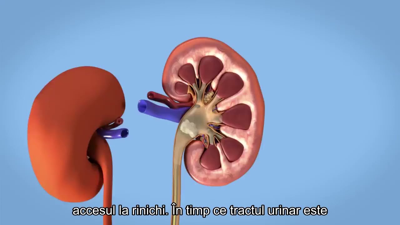 Removal of kidney stones  PCNL 1