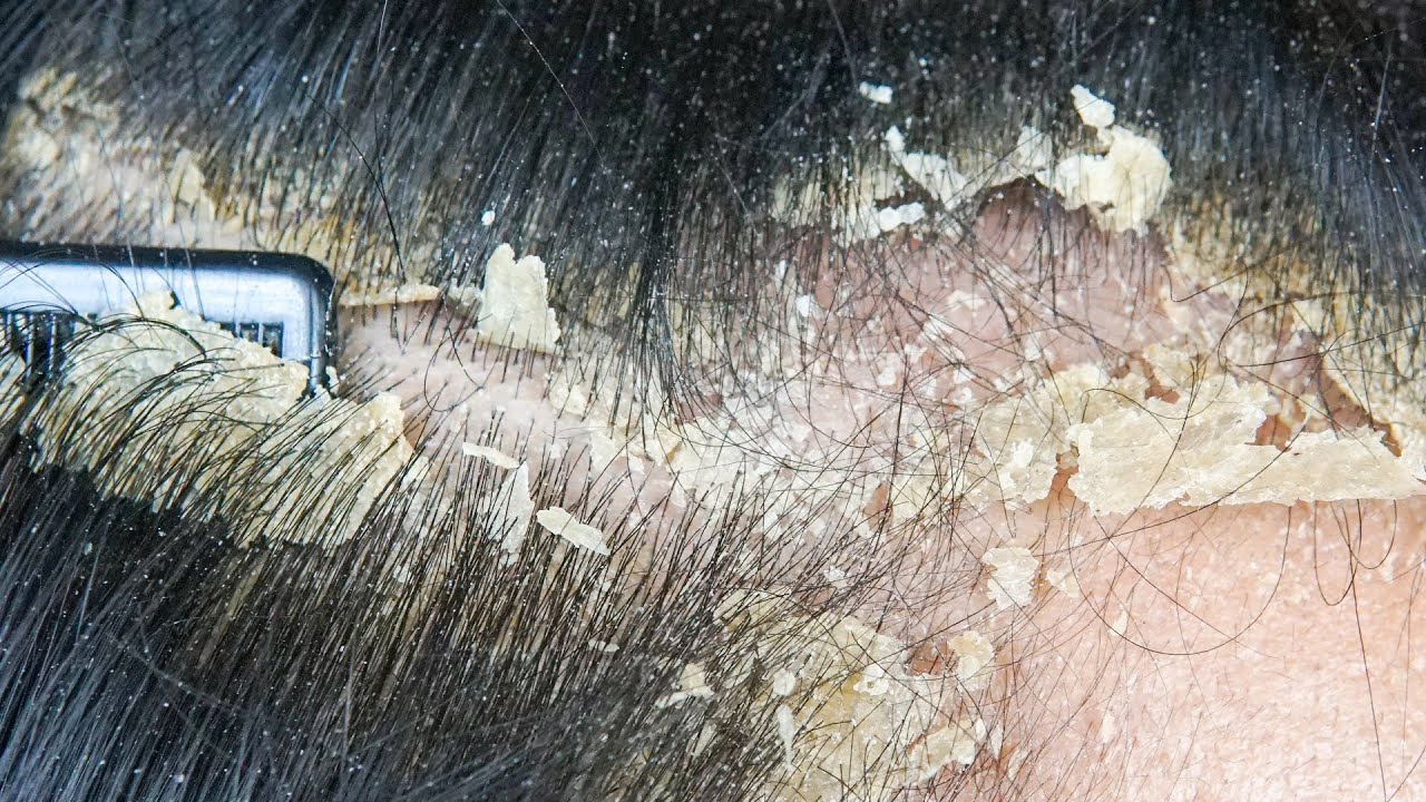 ASMR Scalp Treatment Dandruff Removal | Satisfying Extraction & Calm #44