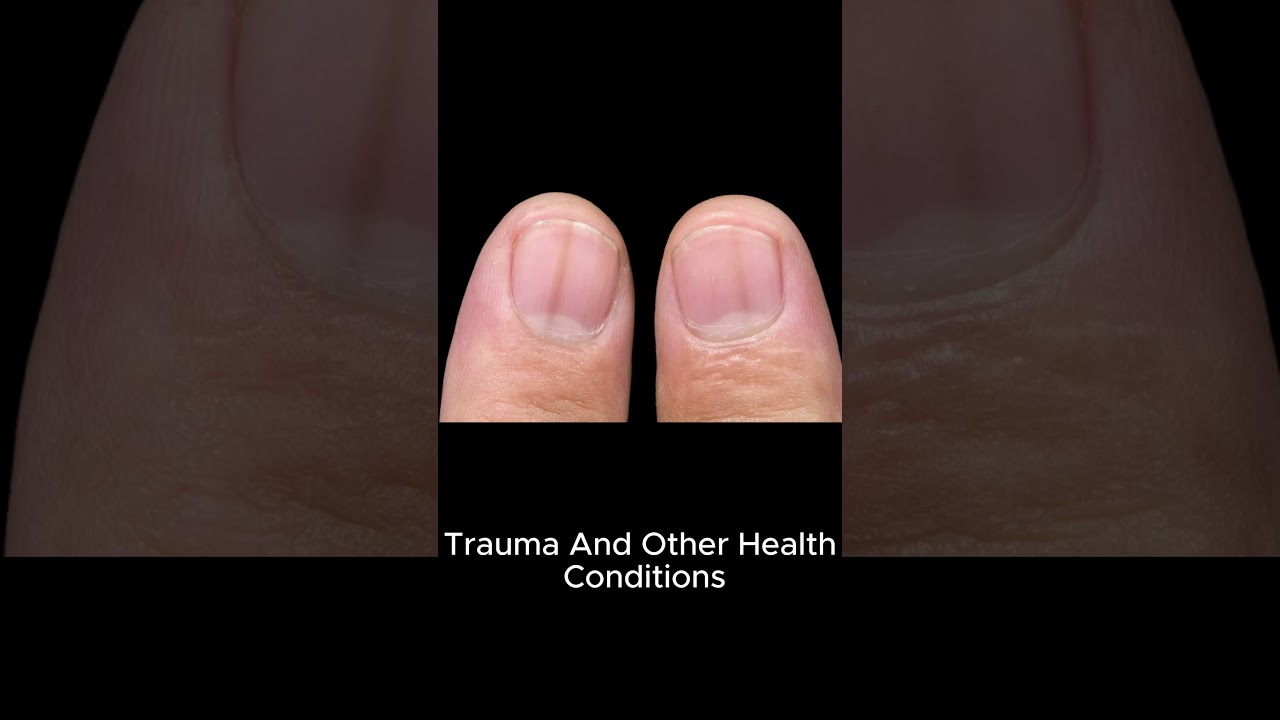 Black lines in nails Streaks on NailMelanonychia Causes & Treatment