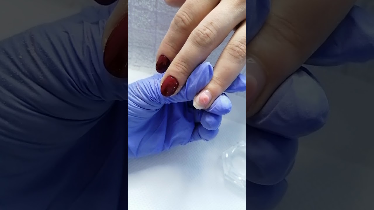 Συντήρηση με acrygel