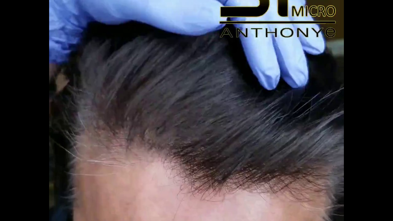 Scalp Micropigmentation for thinning hair increasing hair density