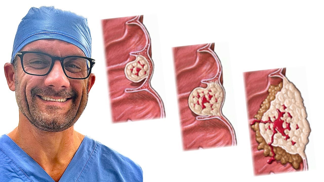 Understanding Treatment for Colon Cancer