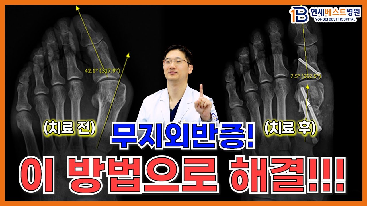 엄지발가락 휘어짐 및 통증 🚨무지외반증! 4세대 MITA 수술 사례 (feat.3세대 MICA)