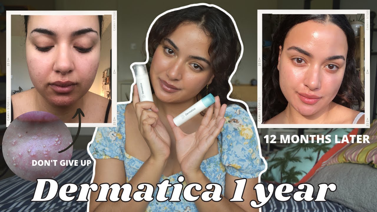 MY SKIN TRANSFORMED! DERMATICA 1 YEAR REVIEW | ADAPALENE & TRETINOIN 0.05 | BEFORE AND AFTER RESULTS