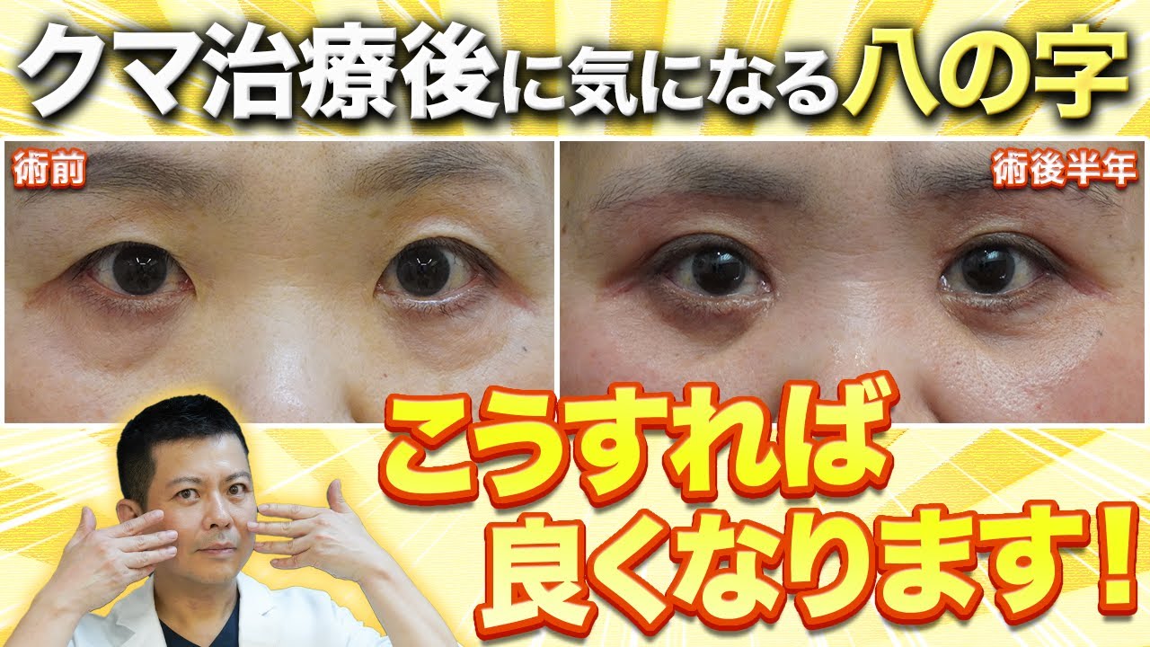 美しさに直結します！クマ治療後の八の字・へこみと蒙古襞の関係を徹底解説します【クマ取り・クマ治療】
