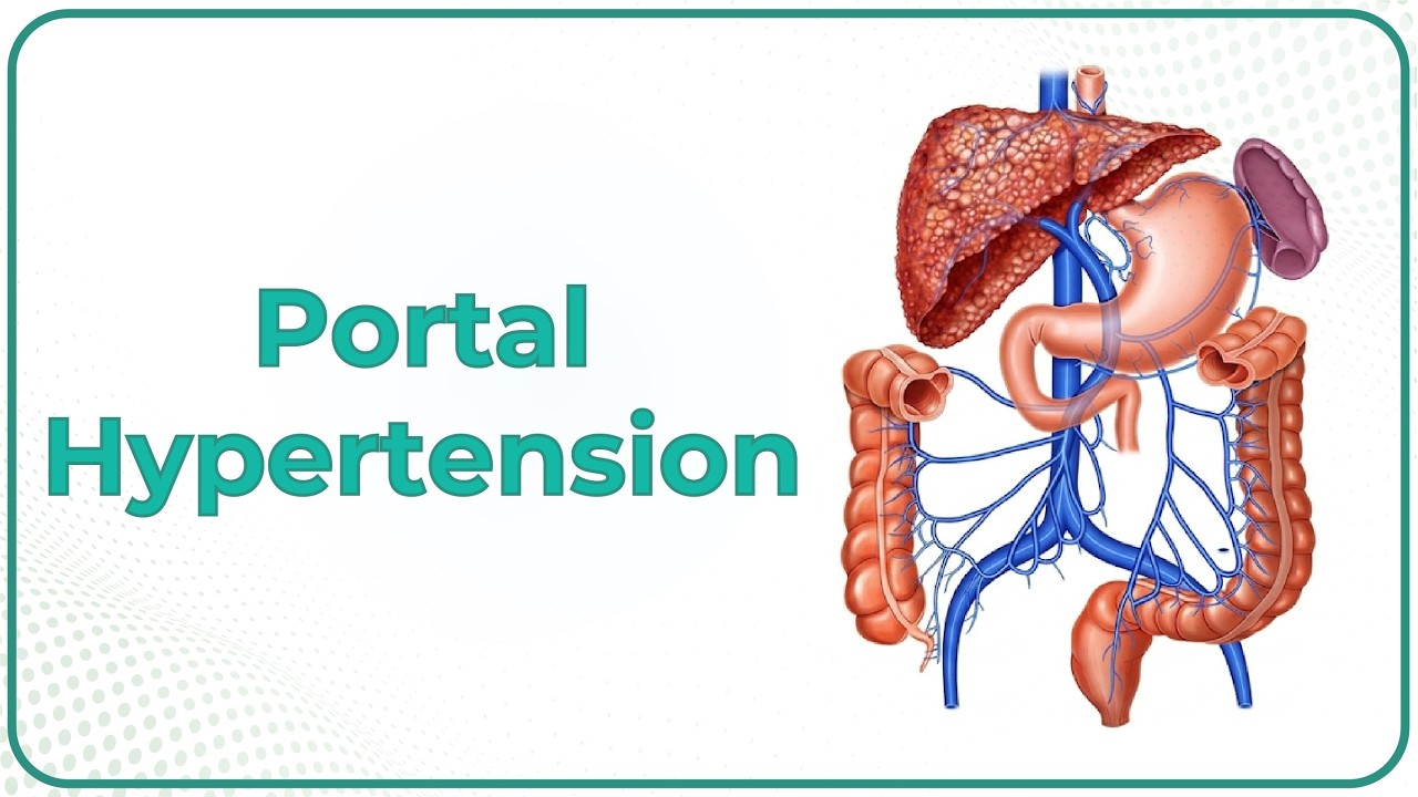 Portal hypertension USMLE Step 1 : Etiology, Clinical features, Diagnosis and Treatment
