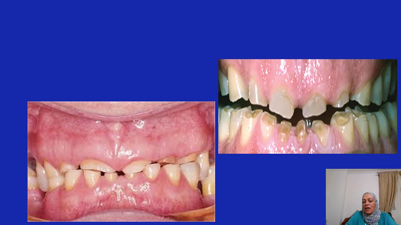 Bite Raising of VDO by Prof Dr. Safaa Asal