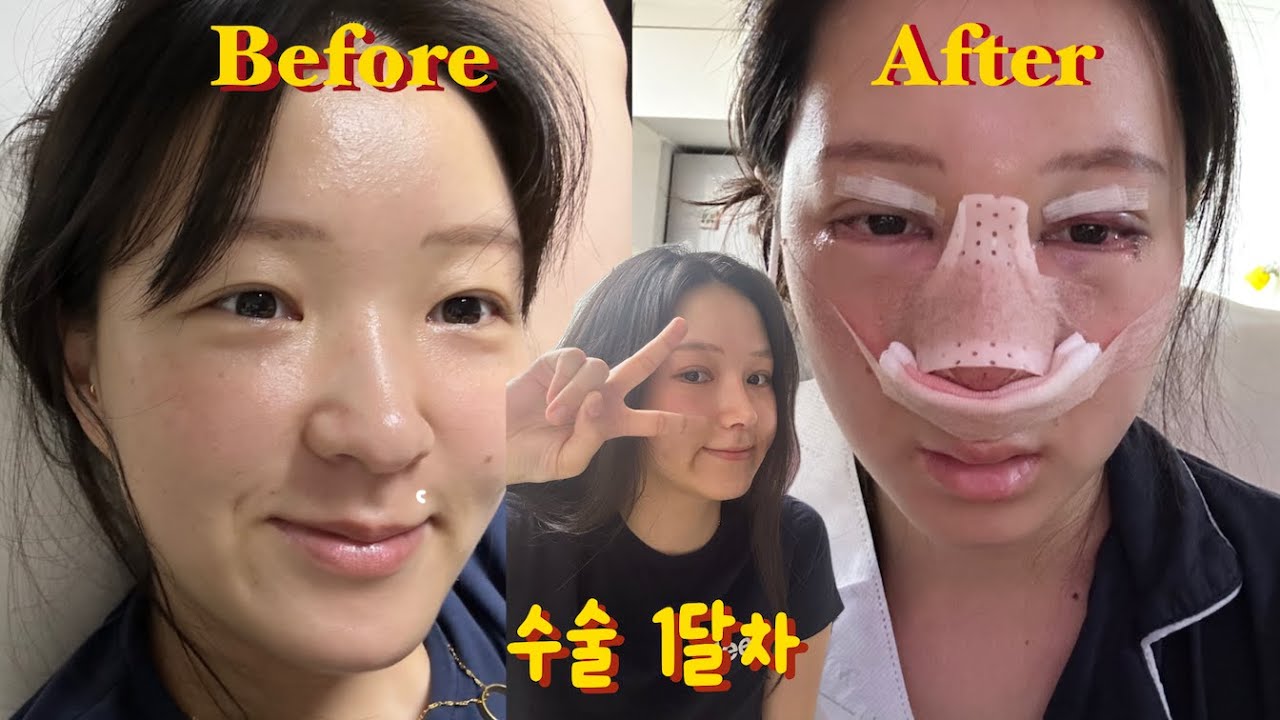 성형 수술 브이로그 | 3주간의 일상: 뮤지컬, 산책, 영화