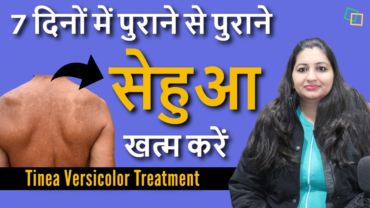 सेहुआ रोग को कीजिए 1 सप्ताह मे जड़ से खत्म | Sehua ka ilaj | Sehua Homeopathic Treatment | Sehua Kit