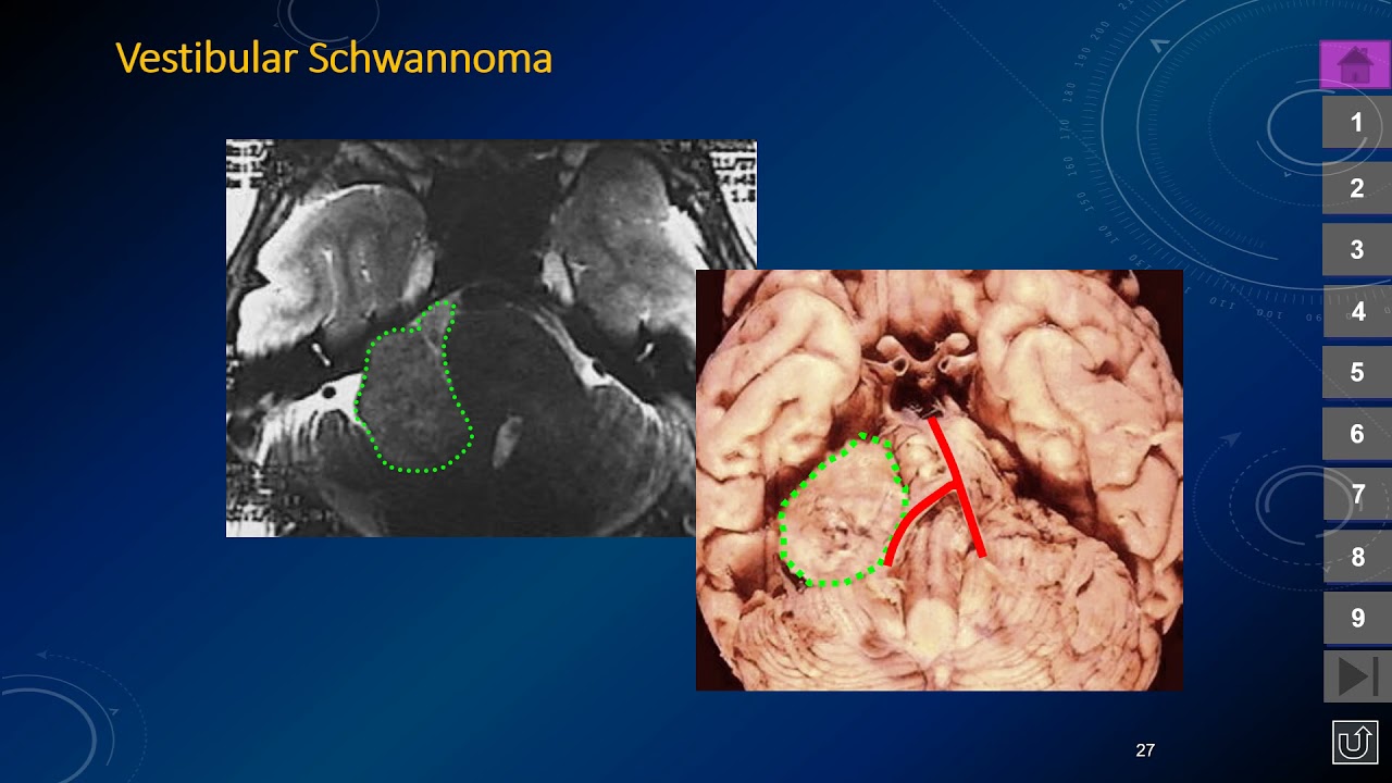 Posterior Fossa Masses