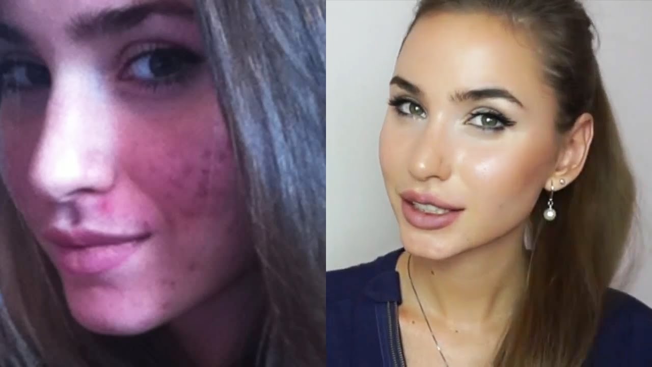 Уход За Проблемной Кожей Лица