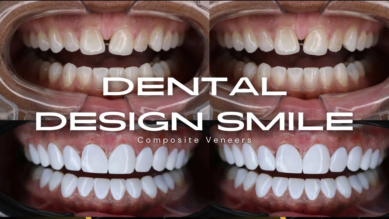 DENTAL DESIGN SMILE | I WENT TO MIAMI TO GET VENEERS | COMPOSITE VENEERS