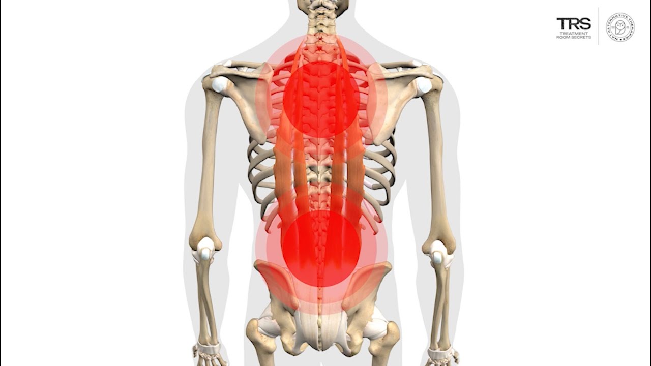 Erector Spinae Trigger Points