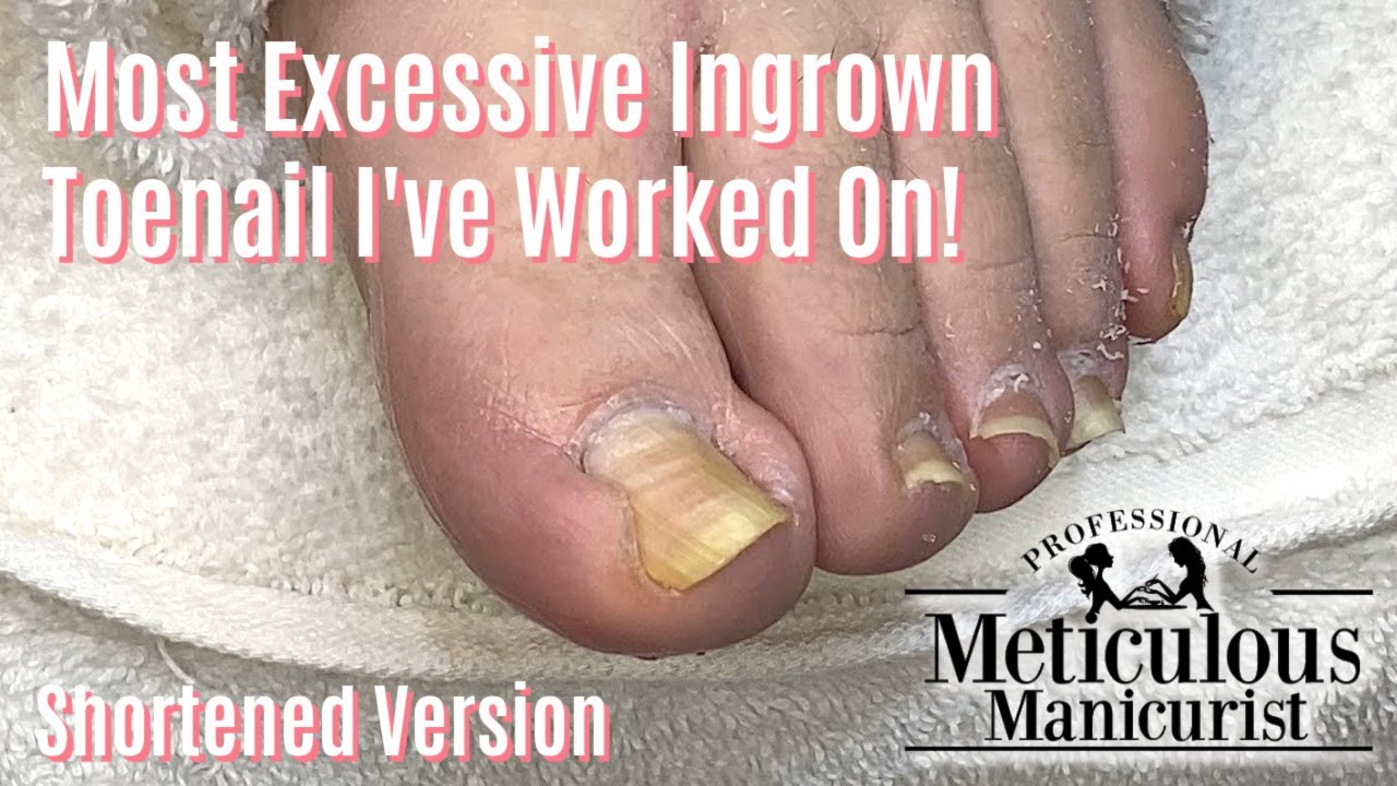 Najbardziej ekstremalny pedicure salonowy na wrastające paznokcie u st&oacute;p &ndash; skr&oacute;cony