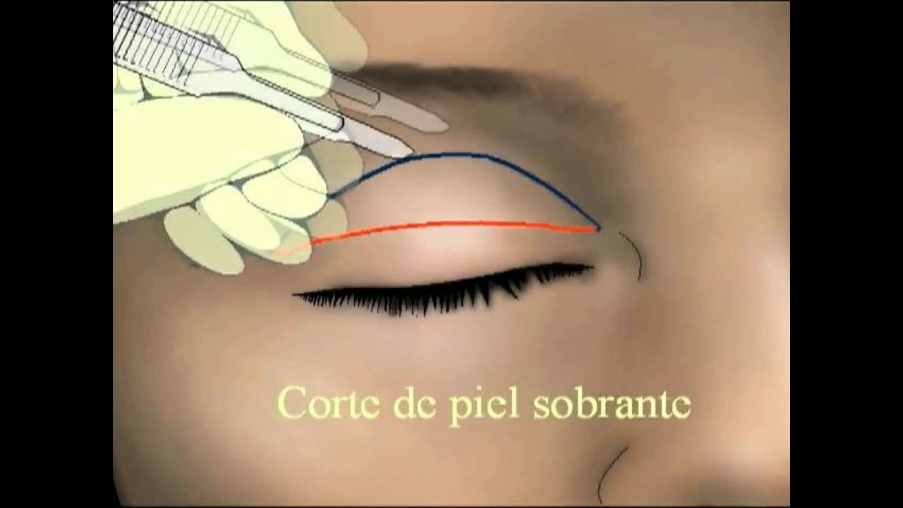 BLEFAROPLASTIA O CIRUGIA DE PARPADO SUPERIOR  * INNOPLASTICA*