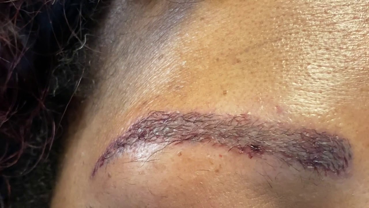 Dallas African-American Eyebrow Transplant Closeup One Day After