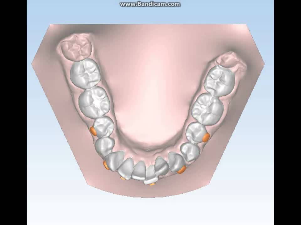 Ortodonzia Invisibile Aurodental 18