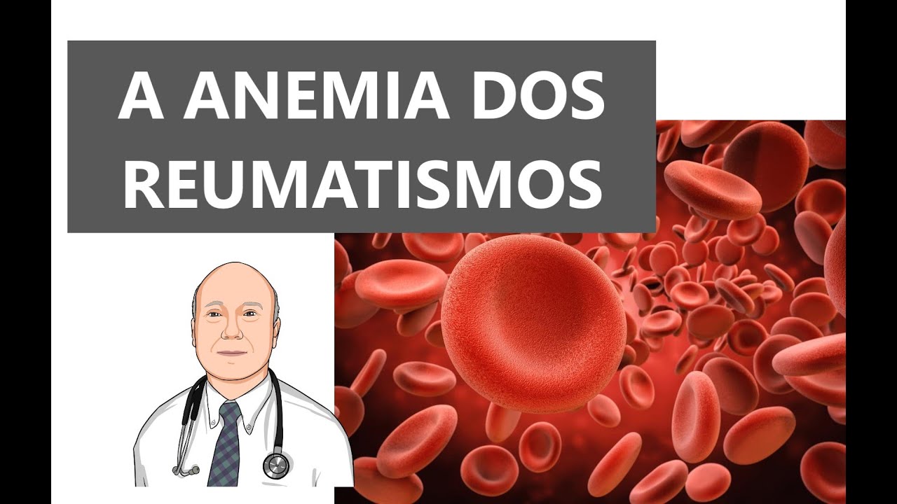 Anemia de doenças reumáticas crônicas: tudo o que você precisa saber, do diagnóstico ao tratamento.