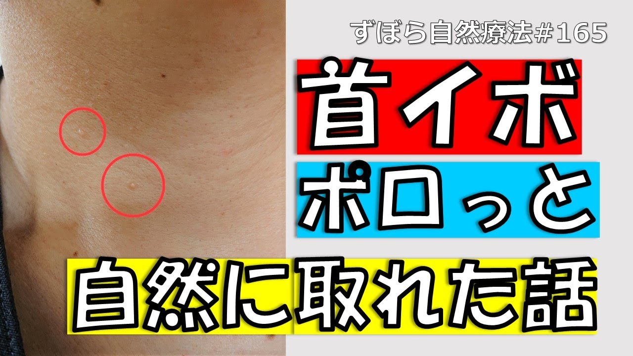 首イボ　ポロっと自然に取れた話　ずぼら自然療法#165