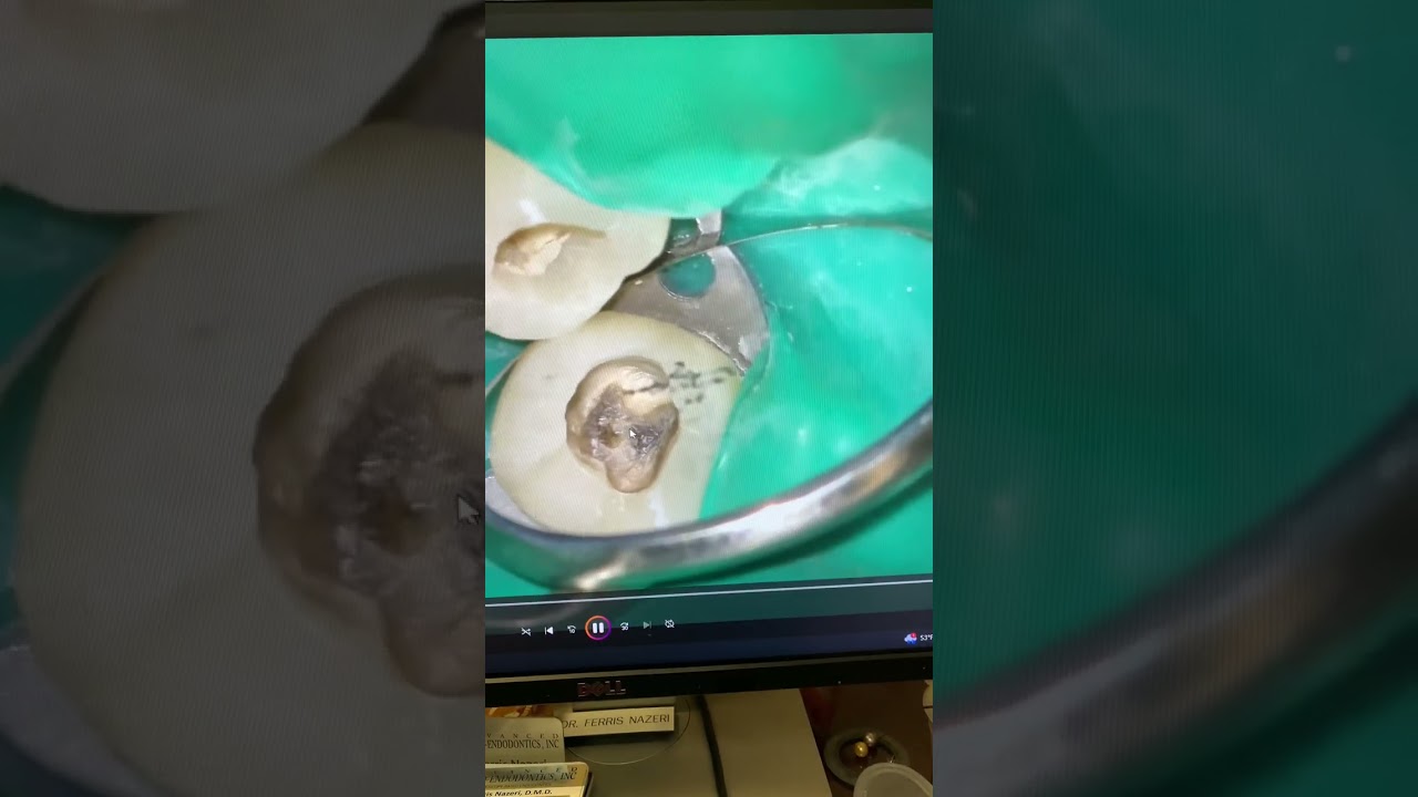 POV Zumax 2380 R2 начинает и заканчивает эндодонтическое лечение кальцинированного зуба № 19.