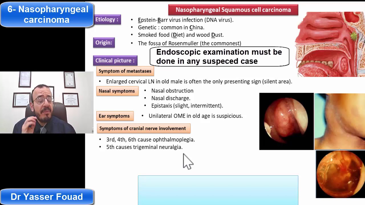 6-  Nasopharyngeal Carcinoma
