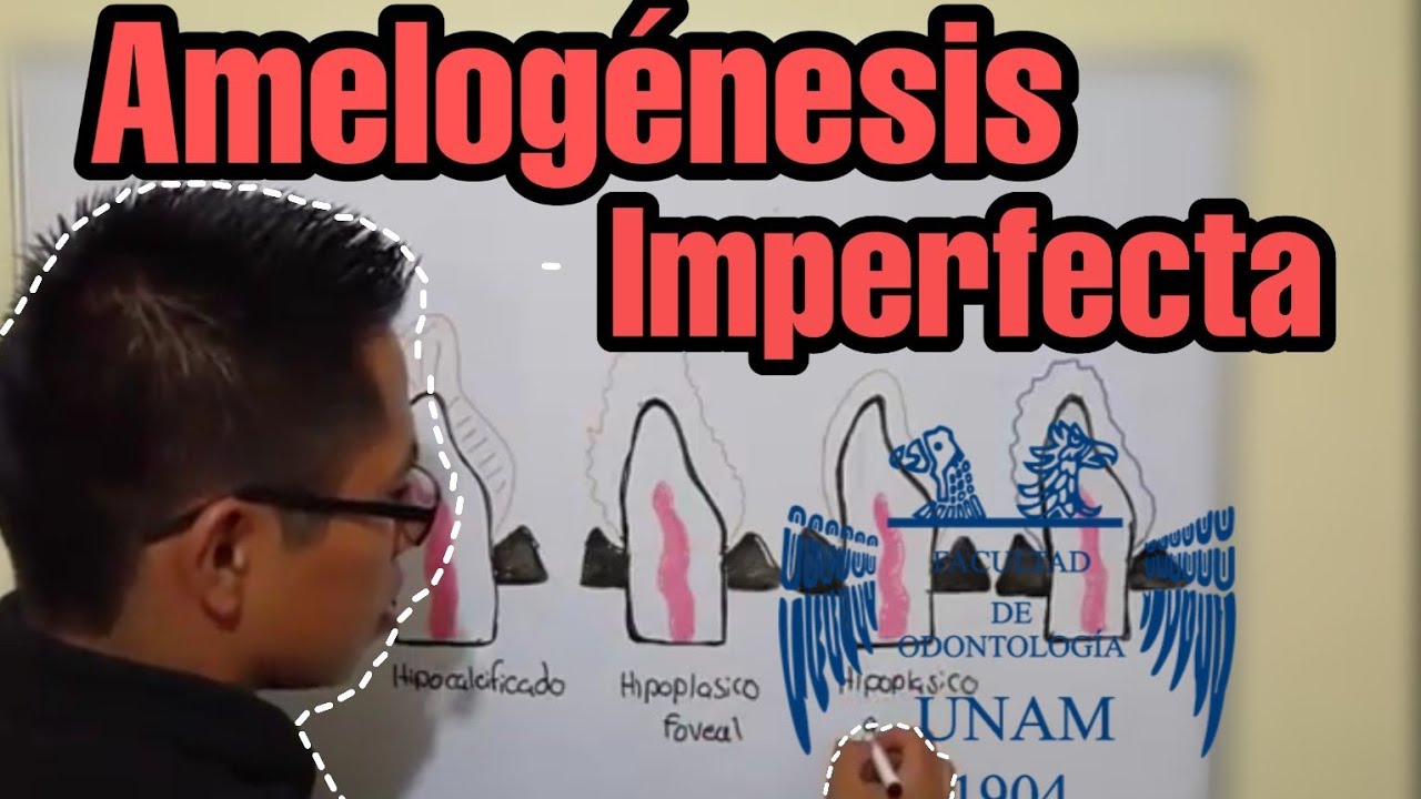 Amelogénesis Imperfecta