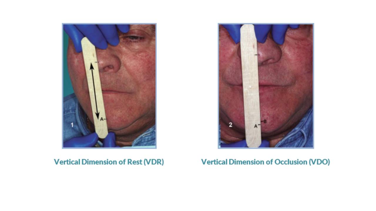 Vertical Dimension