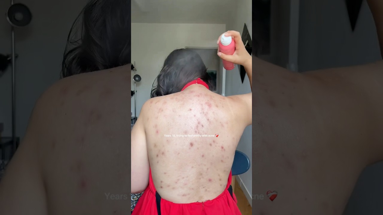 It's not easy to feel pretty when you have acne, right? 🥹 #makeup #skincare #acne