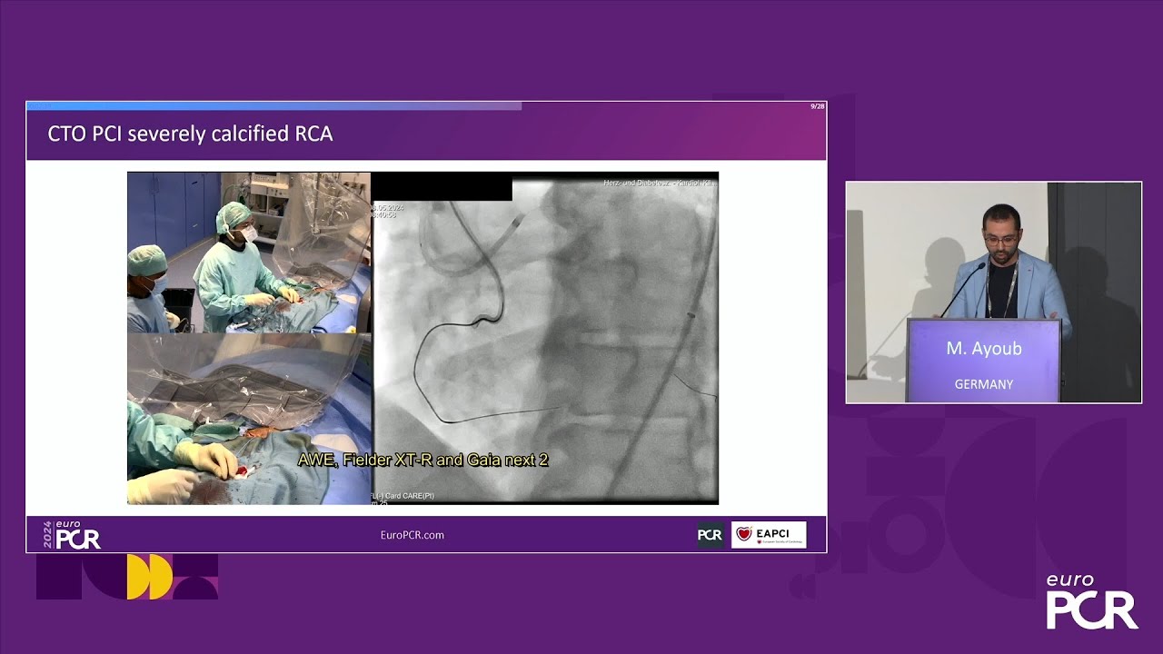 Physiology guided post-DCB treatment to safely limit stenting - EuroPCR 2024