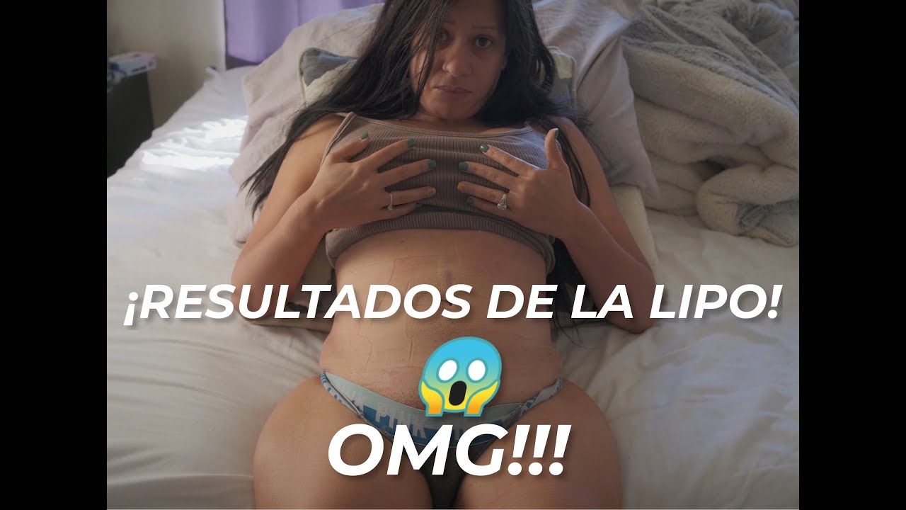 Vlog 5: Día 7 - ¡Primer baño en una semana y vemos la liposucción por primera vez y  nuevos masajes!
