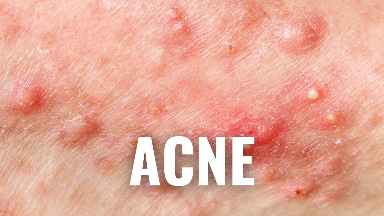 If You’re Prone to ACNE, Avoid These 8 Things for Clearer, Healthier Skin