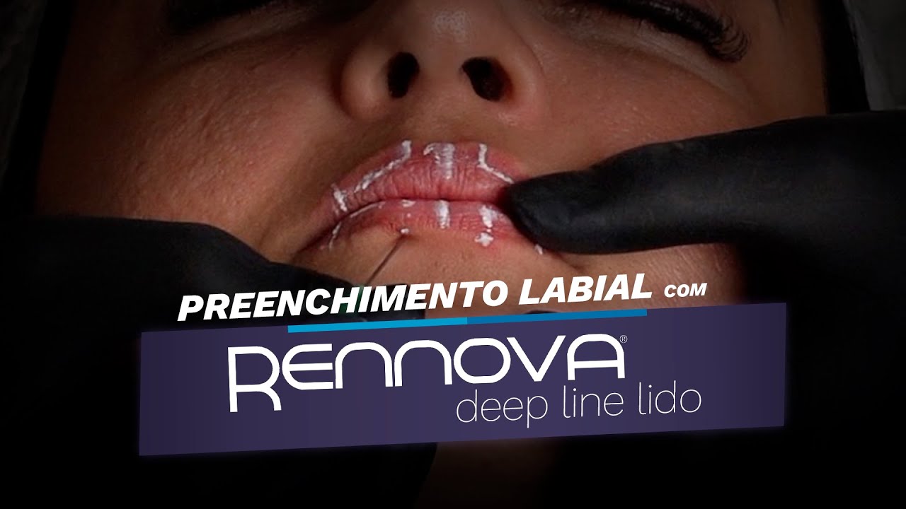 Preenchimento Labial com RENNOVA DEEP LINE | Aula Prática que Todo Profissional Precisa Ver