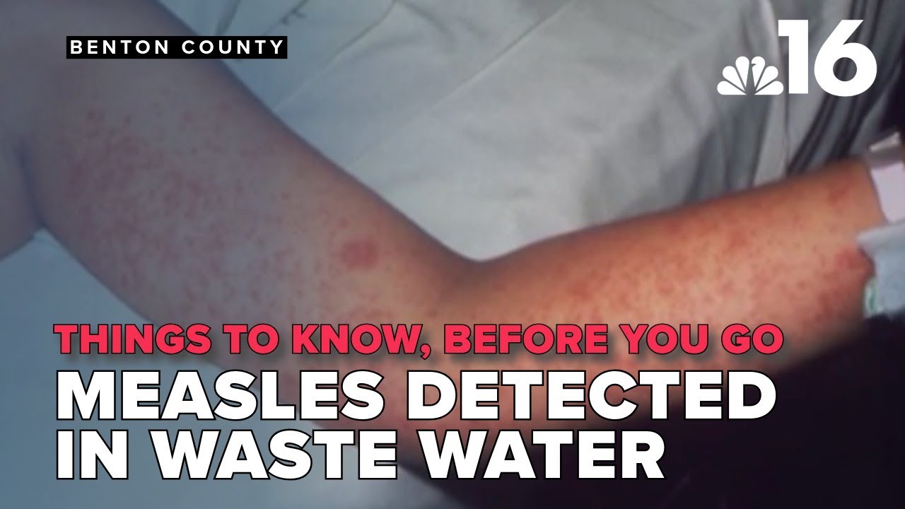 Things to know, before you go: Measles dected in Benton County wastewater