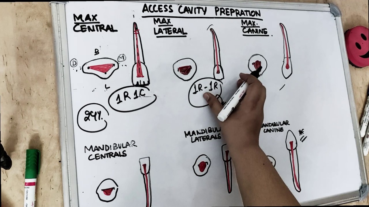 access cavity preparation - anterior teeth