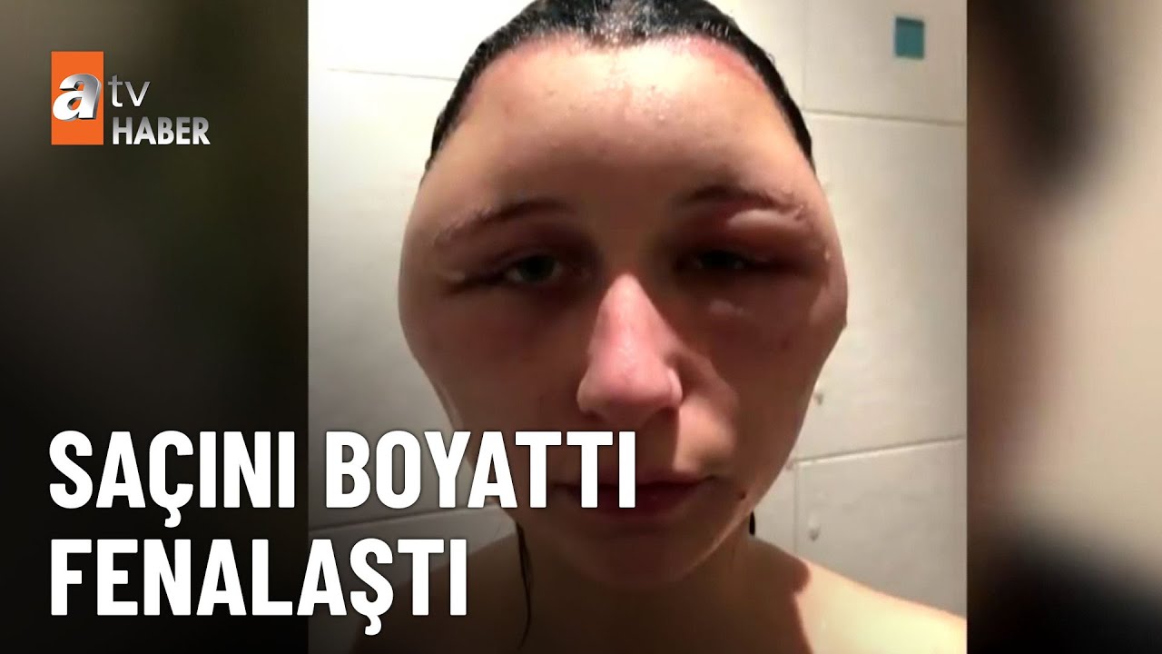 Saç boyası alerjisine dikkat! - atv Ana Haber 13 Ekim 2025