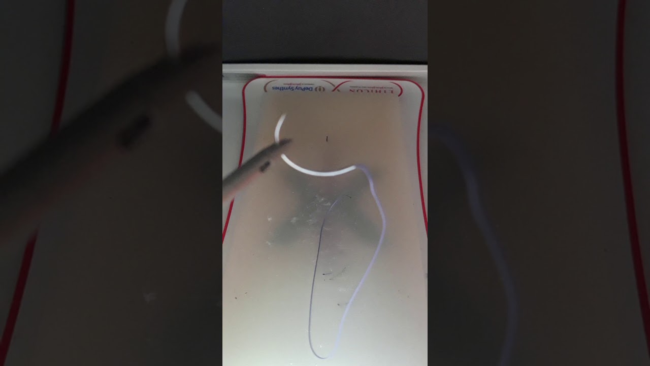 Laparoscopic intracorporeal suture: Gladiator technique from Dr Romeo.