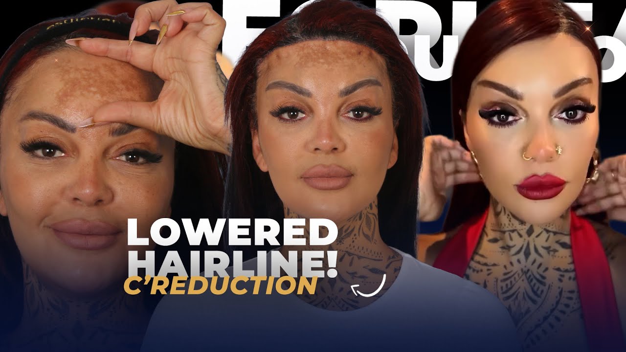 Forehead Reduction Journey — From Day 2 to 4 Months | Real Patient Timeline in Istanbul